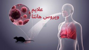 علائم ویروس هانتا