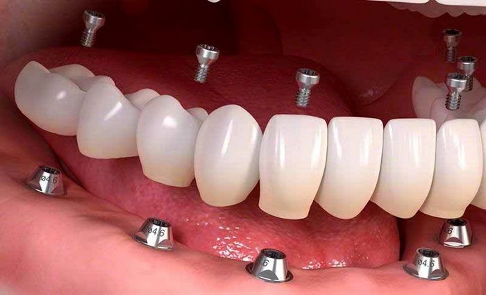 کاشت دندان چیست؟ مراحل و مزایای آن