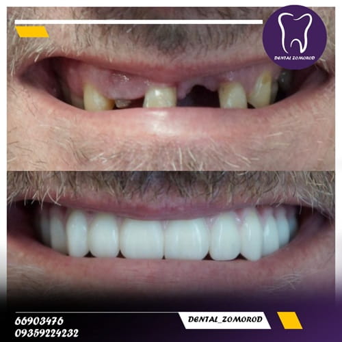 عکس قبل و بعد از کشیدن دندان و ایمپلنت دندان کلینیک دندانپزشکی زمرد تهران میدان خبر و مشاوره رایگان دندانپزشکی