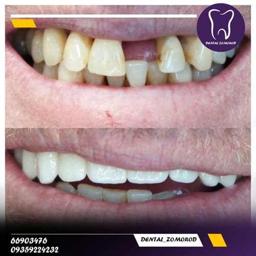 تصویر قبل و بعد از ایمپلنت و زیبایی دندان در کلینیک دندانپزشکی زمررود تهران میدان انقلاب