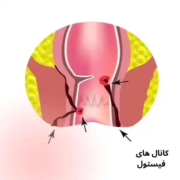 فیستول چیست